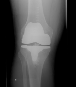 Artroplastia de rodilla a medida